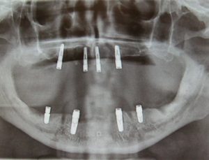 På fotoet ses tandløse kæber med 8 implantater, som så kan få "påklikket" proteser, men der kan også laves fastsiddende broer/tænder. foto:HW.